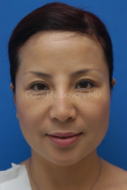 Fat Injection Face Before and After | Sayah Institute
