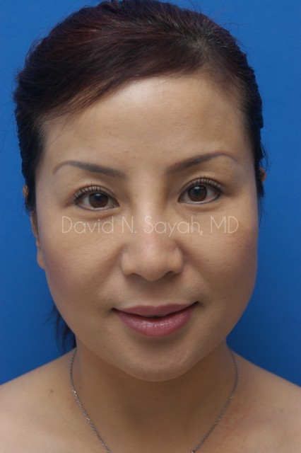 Fat Injection Face Before and After | Sayah Institute