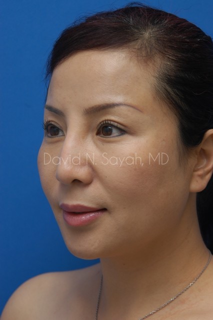 Fat Injection Face Before and After | Sayah Institute