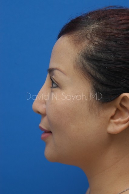 Fat Injection Face Before and After | Sayah Institute