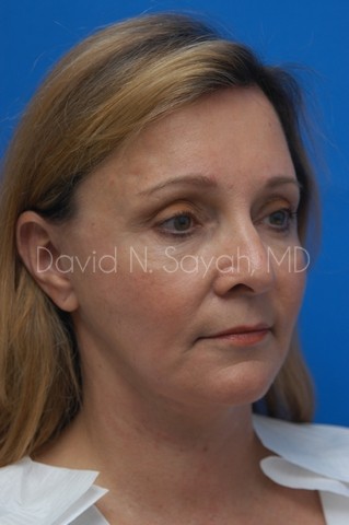 Fat Injection Face Before and After | Sayah Institute