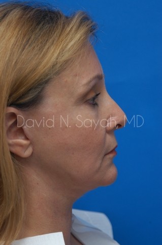 Fat Injection Face Before and After | Sayah Institute