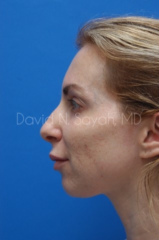 Fat Injection Face Before and After | Sayah Institute