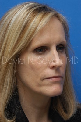 Fat Injection Face Before and After | Sayah Institute