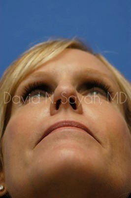 Fat Injection Face Before and After | Sayah Institute