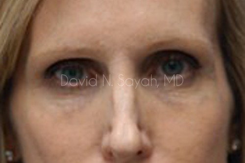 Fat Injection Face Before and After | Sayah Institute