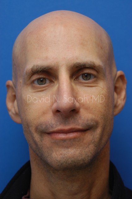 Fat Injection Face Before and After | Sayah Institute