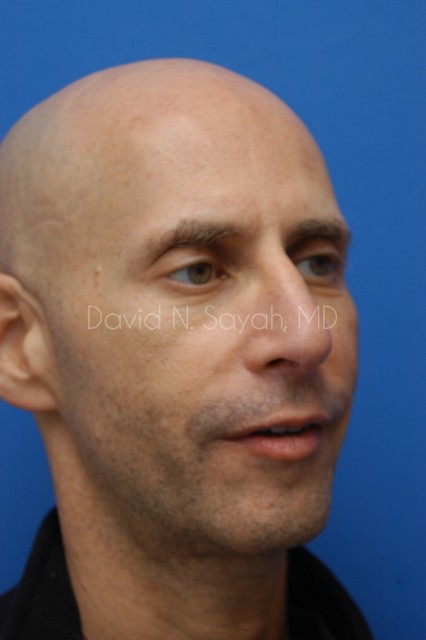 Fat Injection Face Before and After | Sayah Institute