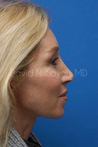 Fat Injection Face Before and After | Sayah Institute