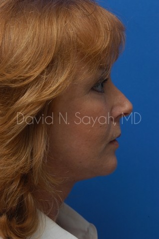 Fat Injection Face Before and After | Sayah Institute