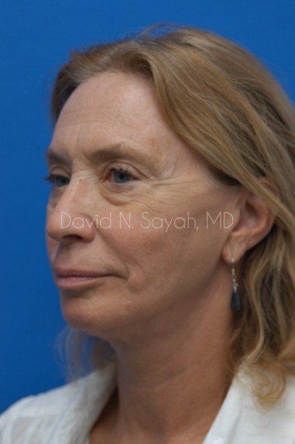 Fat Injection Face Before and After | Sayah Institute