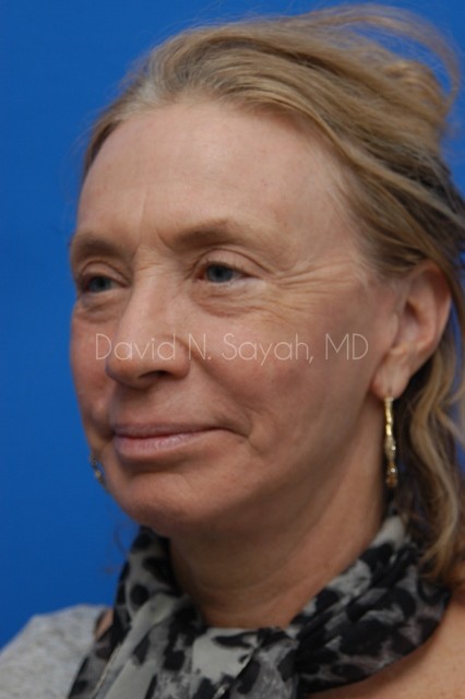 Fat Injection Face Before and After | Sayah Institute