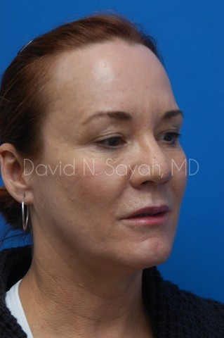 Fat Injection Face Before and After | Sayah Institute