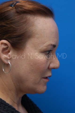Fat Injection Face Before and After | Sayah Institute
