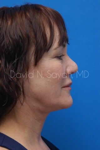 Fat Injection Face Before and After | Sayah Institute