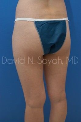 Gluteal Augmentation Before and After | Sayah Institute