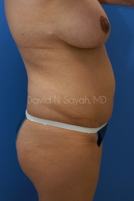 Gluteal Augmentation Before and After | Sayah Institute
