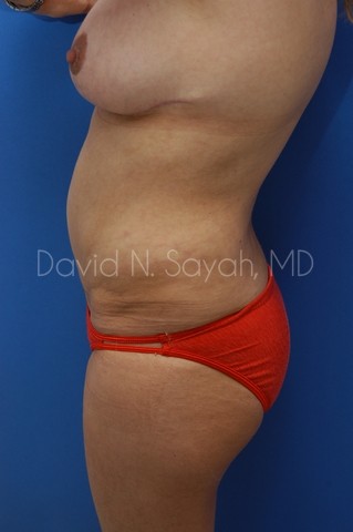 Gluteal Augmentation Before and After | Sayah Institute