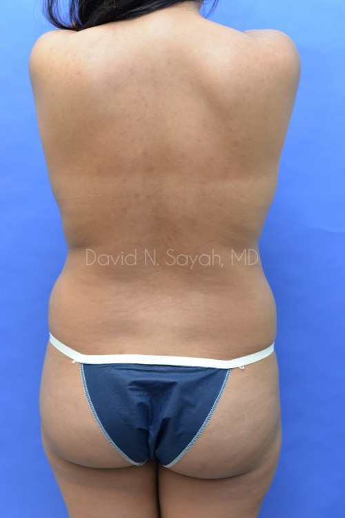 Liposuction Before and After | Sayah Institute