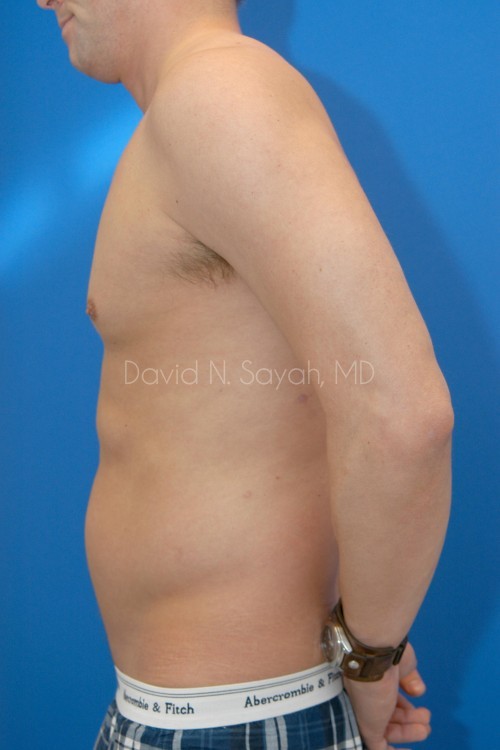 Liposuction Before and After | Sayah Institute
