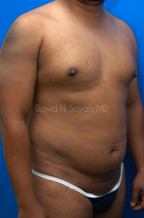 Liposuction Before and After | Sayah Institute