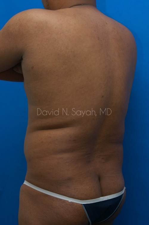 Liposuction Before and After | Sayah Institute