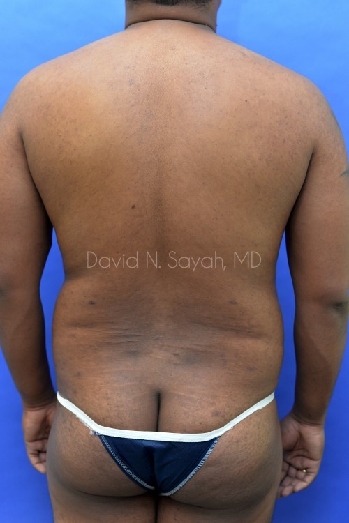 Liposuction Before and After | Sayah Institute