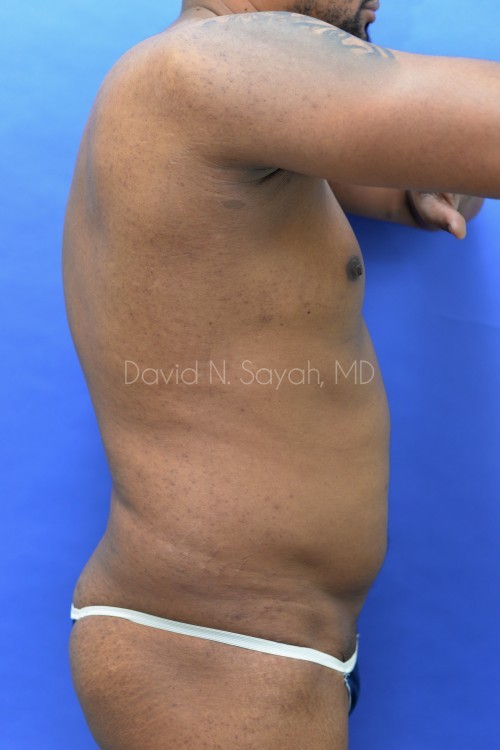 Liposuction Before and After | Sayah Institute