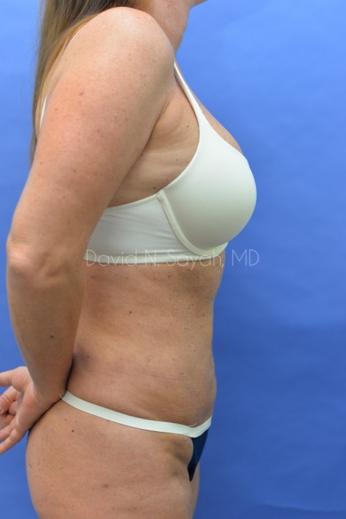 Liposuction Before and After | Sayah Institute