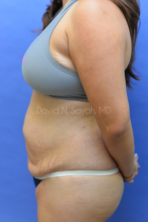 Liposuction Before and After | Sayah Institute