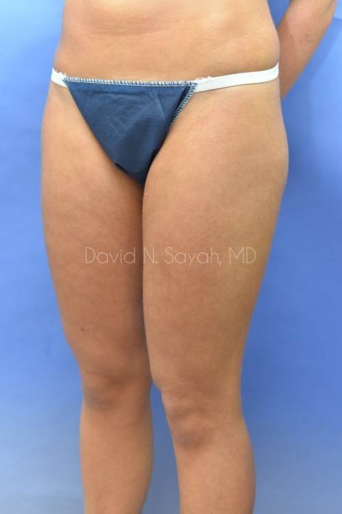 Liposuction Before and After | Sayah Institute