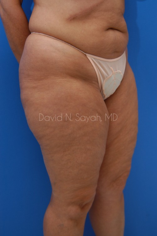 Liposuction Before and After | Sayah Institute