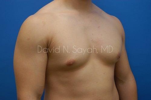 Liposuction Before and After | Sayah Institute
