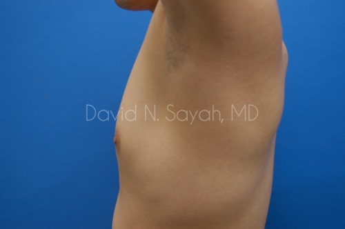 Liposuction Before and After | Sayah Institute