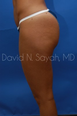 Liposuction Before and After | Sayah Institute
