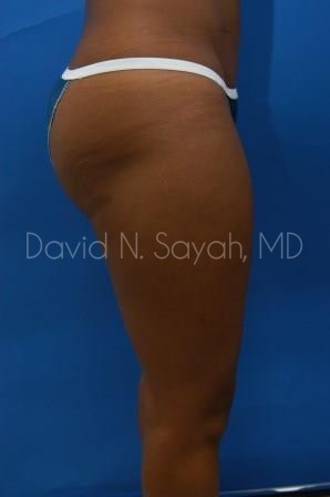 Liposuction Before and After | Sayah Institute