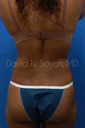 Liposuction Before and After | Sayah Institute