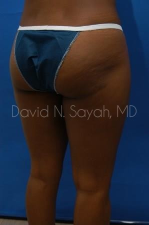 Liposuction Before and After | Sayah Institute