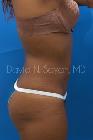 Liposuction Before and After | Sayah Institute