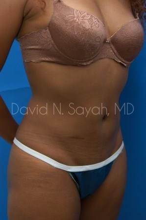 Liposuction Before and After | Sayah Institute
