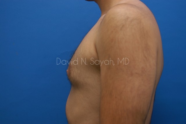 Liposuction Before and After | Sayah Institute