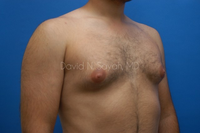 Liposuction Before and After | Sayah Institute