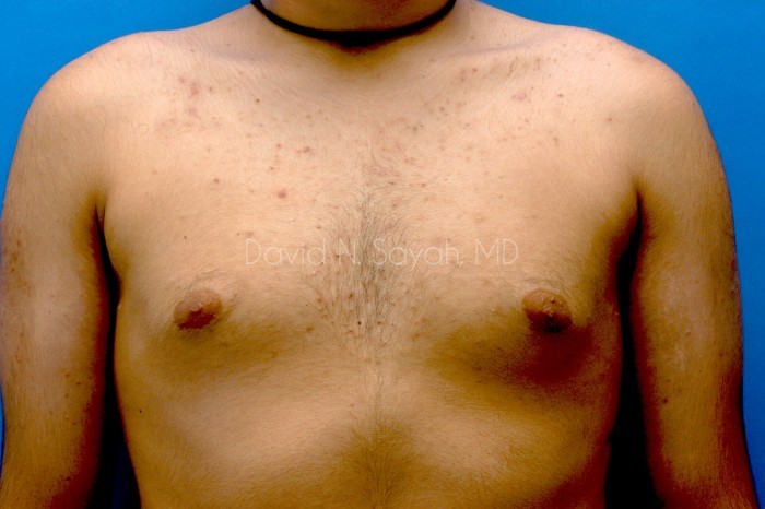 Liposuction Before and After | Sayah Institute