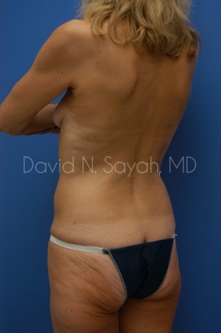Liposuction Before and After | Sayah Institute