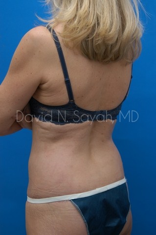 Liposuction Before and After | Sayah Institute