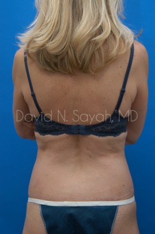 Liposuction Before and After | Sayah Institute