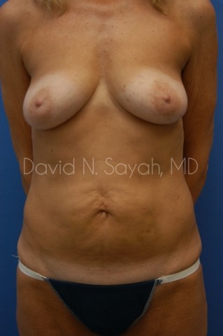 Liposuction Before and After | Sayah Institute