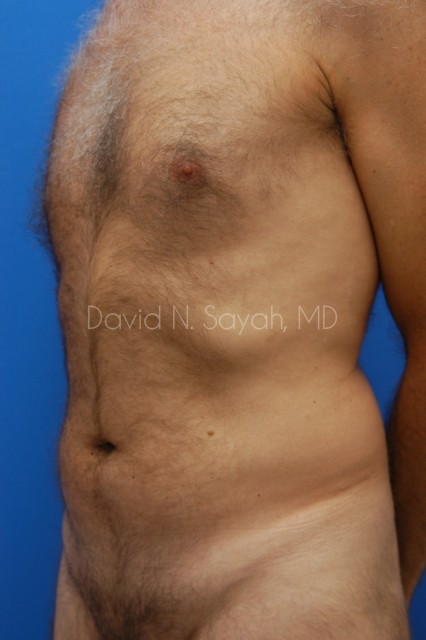 Liposuction Before and After | Sayah Institute