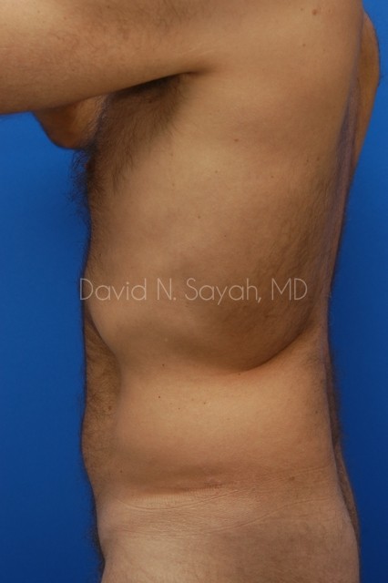 Liposuction Before and After | Sayah Institute