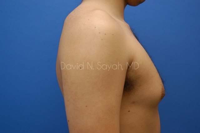 Liposuction Before and After | Sayah Institute